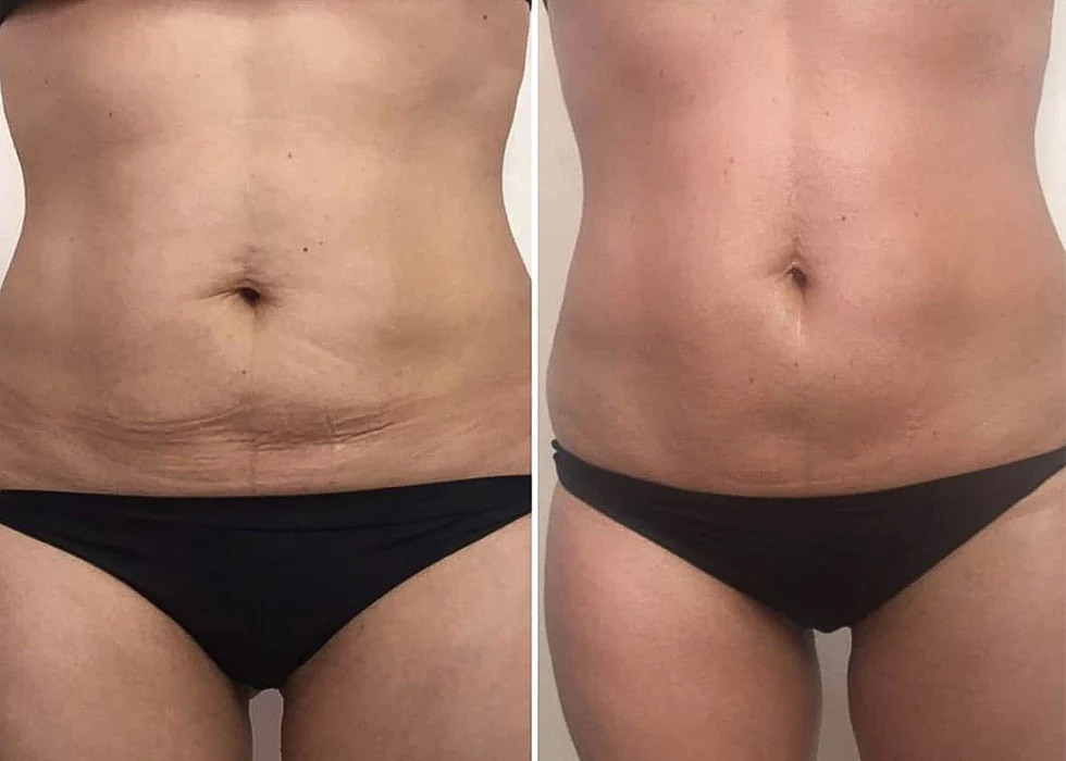 Enveloppement BIOSLIMMING Active Wrap, soin minceur à l'Institut Massage Home